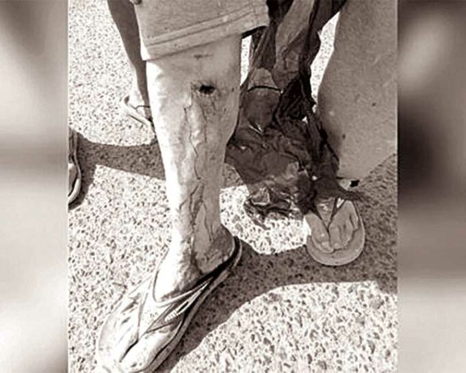 Perro pitbull ataca a adulto mayor