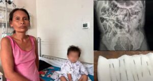 Niño de dos años ingirió ocho agujas inyectables y médicos de Tarapoto le salvan vida(VIDEO)