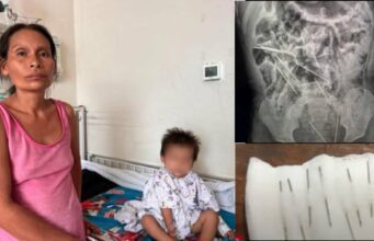 Niño de dos años ingirió ocho agujas inyectables y médicos de Tarapoto le salvan vida(VIDEO)