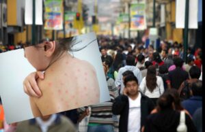 Lima en peligro por el Virus de Sarampión: “Una sola persona puede infectar a 18 a la vez”