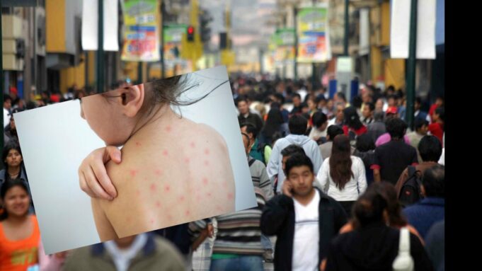 Lima en peligro por el Virus de Sarampión: “Una sola persona puede infectar a 18 a la vez”