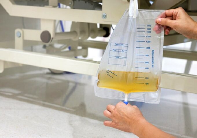 Homologarán bolsa recolectora de orina para facilitar su compra en el Estado en beneficio de pacientes renales