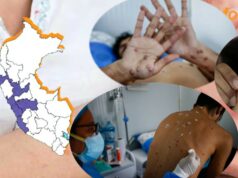 Perú en alerta por la viruela del mono: Cerca de 77 casos se vienen reportando en estas ciudades del país