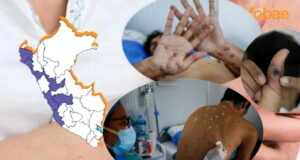 Perú en alerta por la viruela del mono: Cerca de 77 casos se vienen reportando en estas ciudades del país