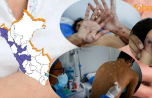 Perú en alerta por la viruela del mono: Cerca de 77 casos se vienen reportando en estas ciudades del país