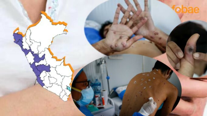 Perú en alerta por la viruela del mono: Cerca de 77 casos se vienen reportando en estas ciudades del país
