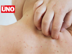 Minsa declara alerta epidemiológica por caso importado de sarampión en niño de 11 años