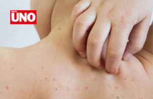 Minsa declara alerta epidemiológica por caso importado de sarampión en niño de 11 años