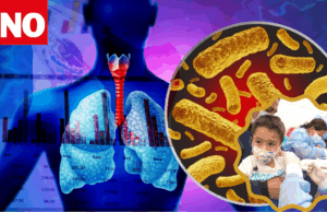 Tos ferina deja 10 muertos y más de 400 casos en Perú