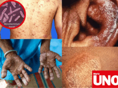 Detectan caso de lepra en Perú