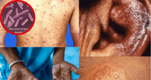 Detectan caso de lepra en Perú