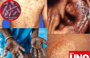 Detectan caso de lepra en Perú