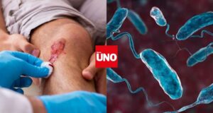 Bacteria come carne en Florida deja 4 muertos y genera alerta