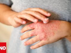 Dermatitis crónica enfermedad en ascenso