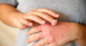 Dermatitis crónica enfermedad en ascenso