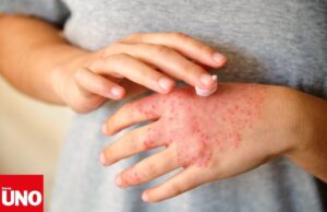 Dermatitis crónica enfermedad en ascenso