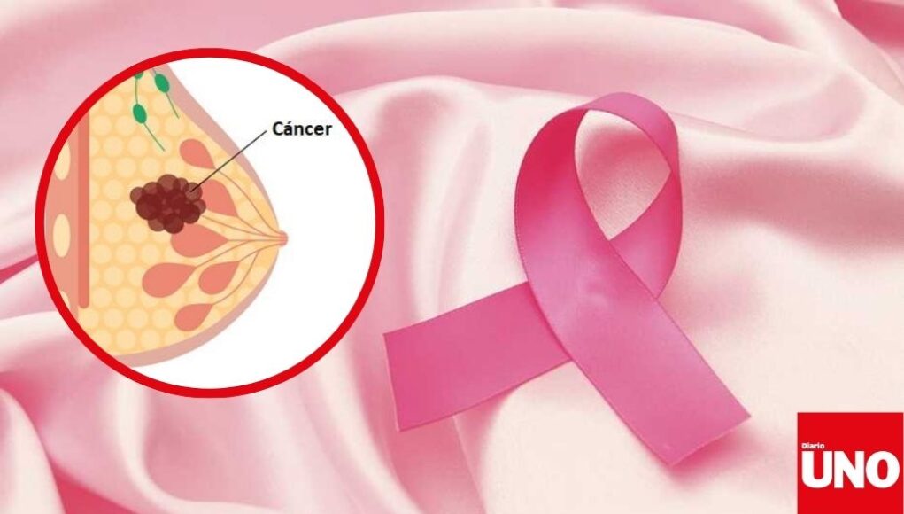 Cáncer de mama sin diagnóstico temprano en Perú