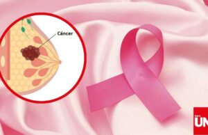 Cáncer de mama sin diagnóstico temprano en Perú