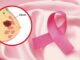 Cáncer de mama sin diagnóstico temprano en Perú