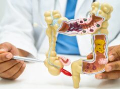 Cáncer de colon: ¿por qué la diarrea o el estreñimiento no deben ignorarse?