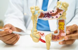 Cáncer de colon: ¿por qué la diarrea o el estreñimiento no deben ignorarse?