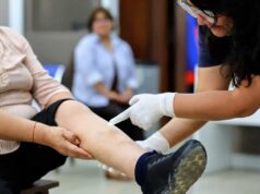 Cuidado con las várices