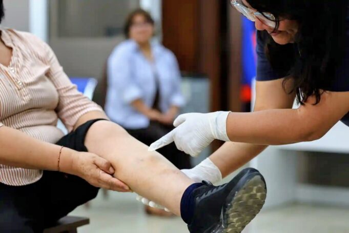 Cuidado con las várices