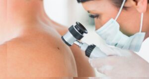 Hospitales del Minsa, Essalud , FF. AA. policiales y clínicas participarán en la campaña nacional “El Día del Lunar”