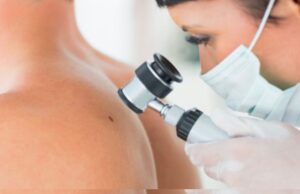 Hospitales del Minsa, Essalud , FF. AA. policiales y clínicas participarán en la campaña nacional “El Día del Lunar”