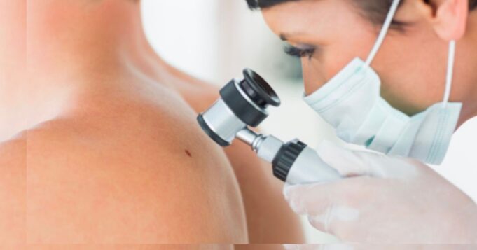 Hospitales del Minsa, Essalud , FF. AA. policiales y clínicas participarán en la campaña nacional “El Día del Lunar”