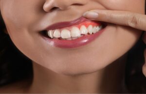 ¿Por qué sangran las encías? Primeros síntomas de alerta que no debes ignorar