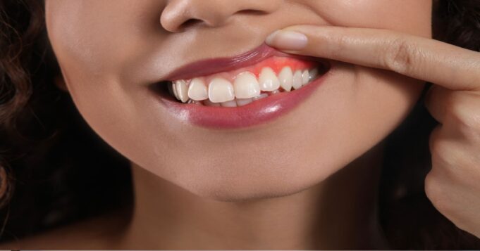 ¿Por qué sangran las encías? Primeros síntomas de alerta que no debes ignorar